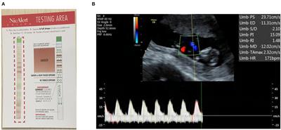 A Pilot Study on Secondhand Smoke Exposure Among Pregnant Women in Chongqing, China: A Combined Questionnaire, Saliva Cotinine Test, and Ultrasound Flow Index Analysis